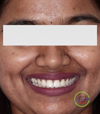 After: Diastema closure