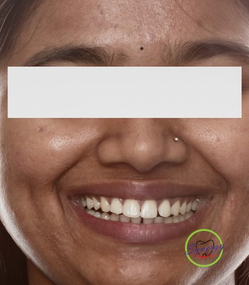 Before: Diastema closure