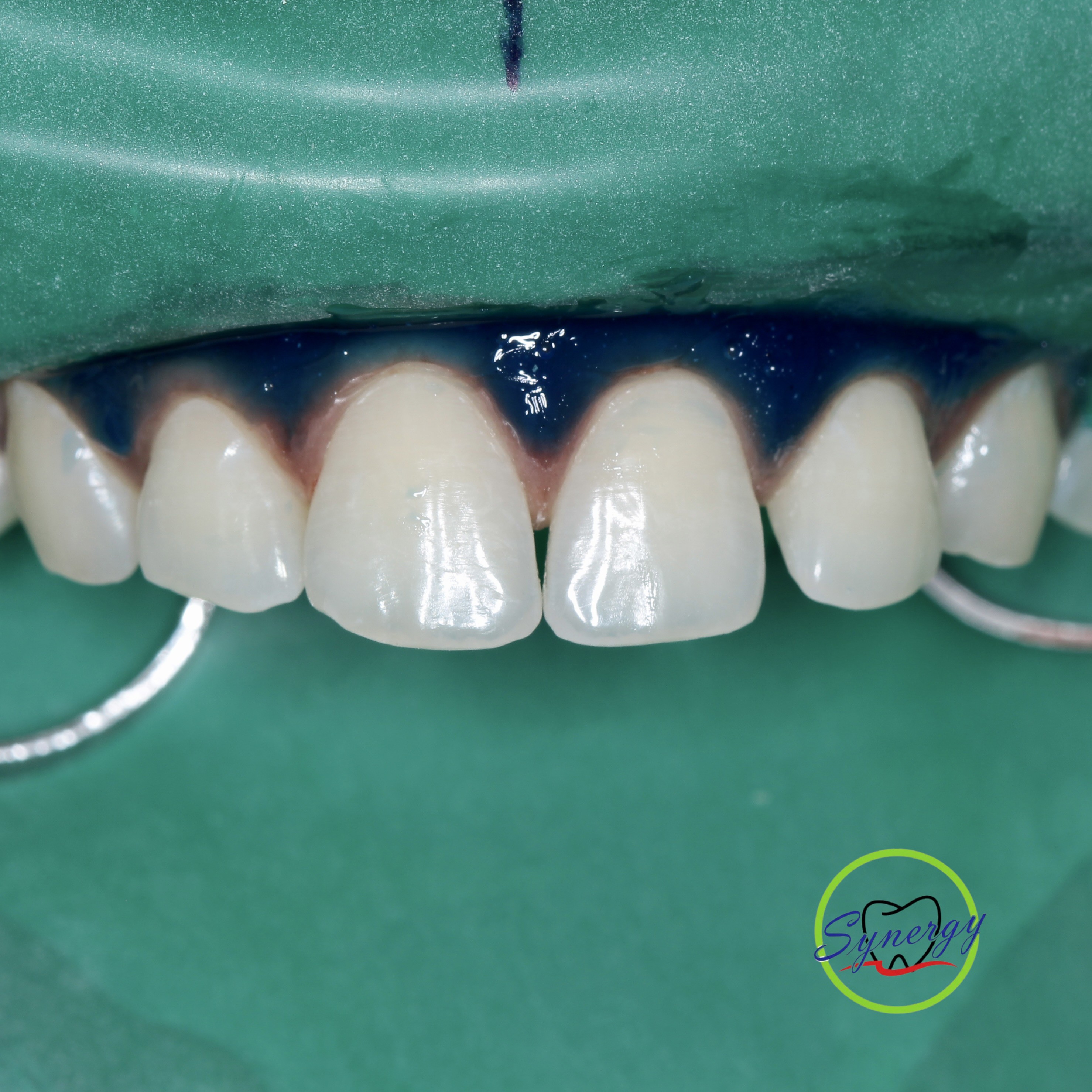 Clinical Isolation