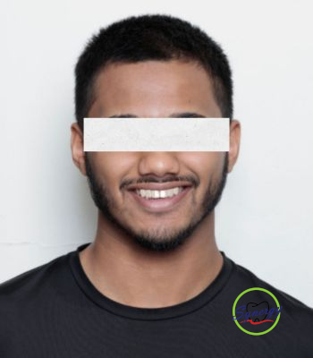 After: Digital Smile Design