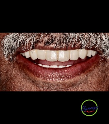 After: Implant Restoration