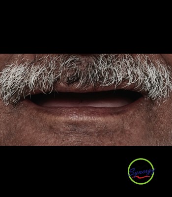 Before: Implant Restoration