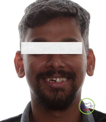 Before: Immediate Implant