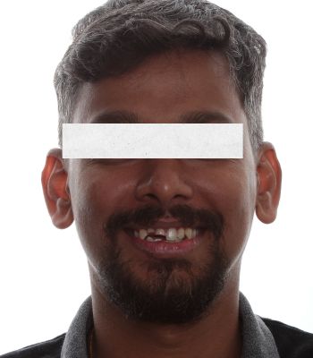 Before: Immediate Implant