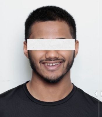 Before: Digital Smile Design