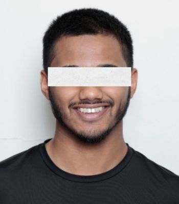 After: Digital Smile Design