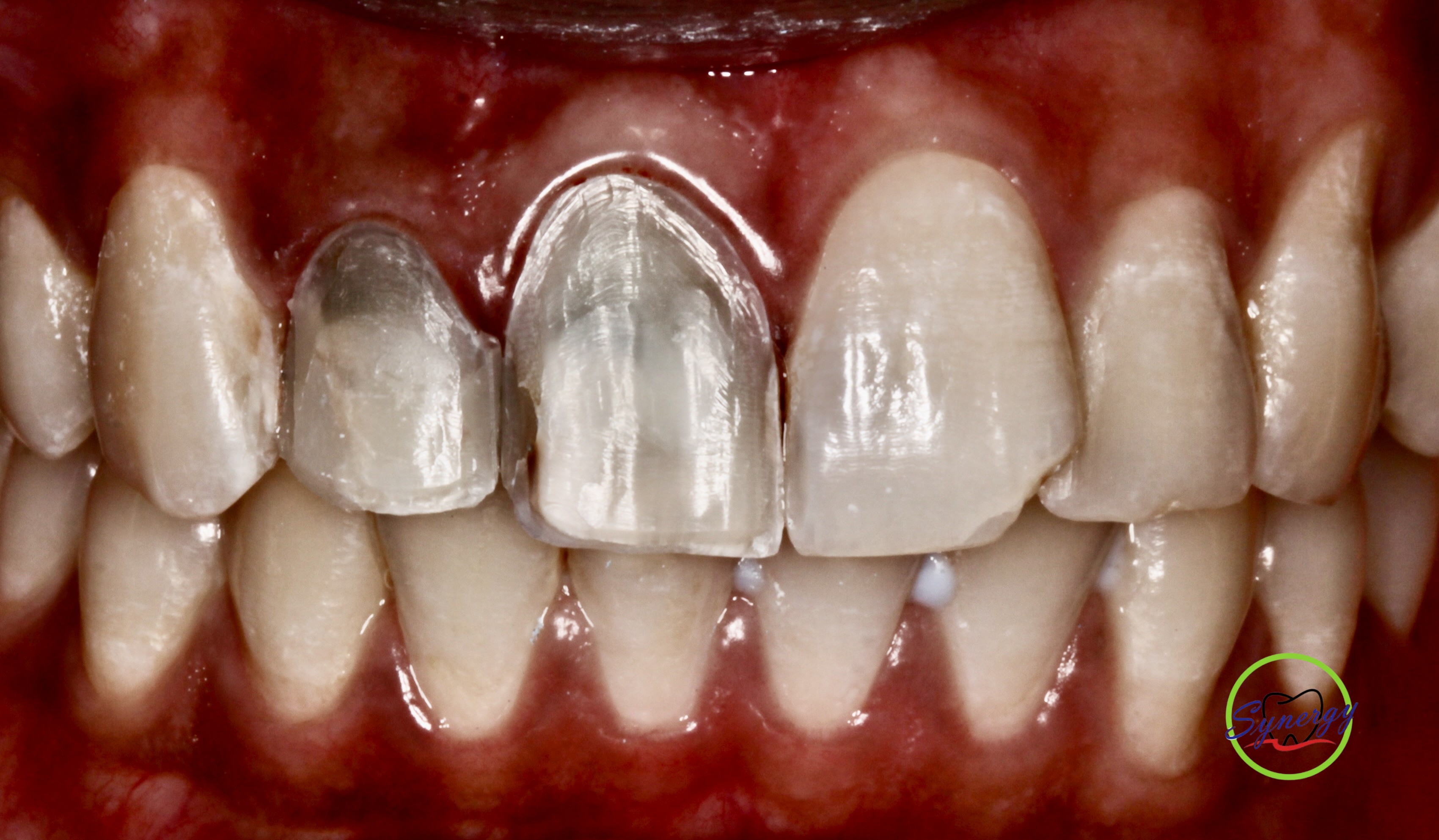 Veneer preparation