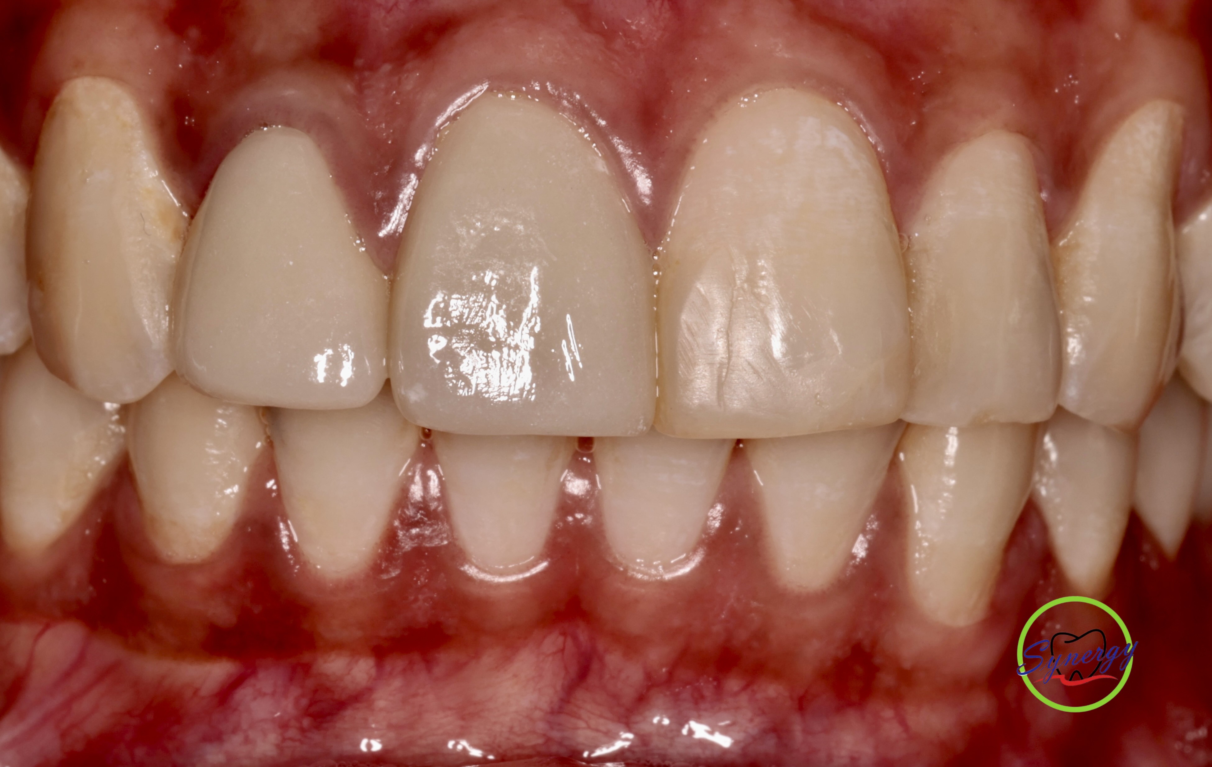 Ceramic veneers cemented
