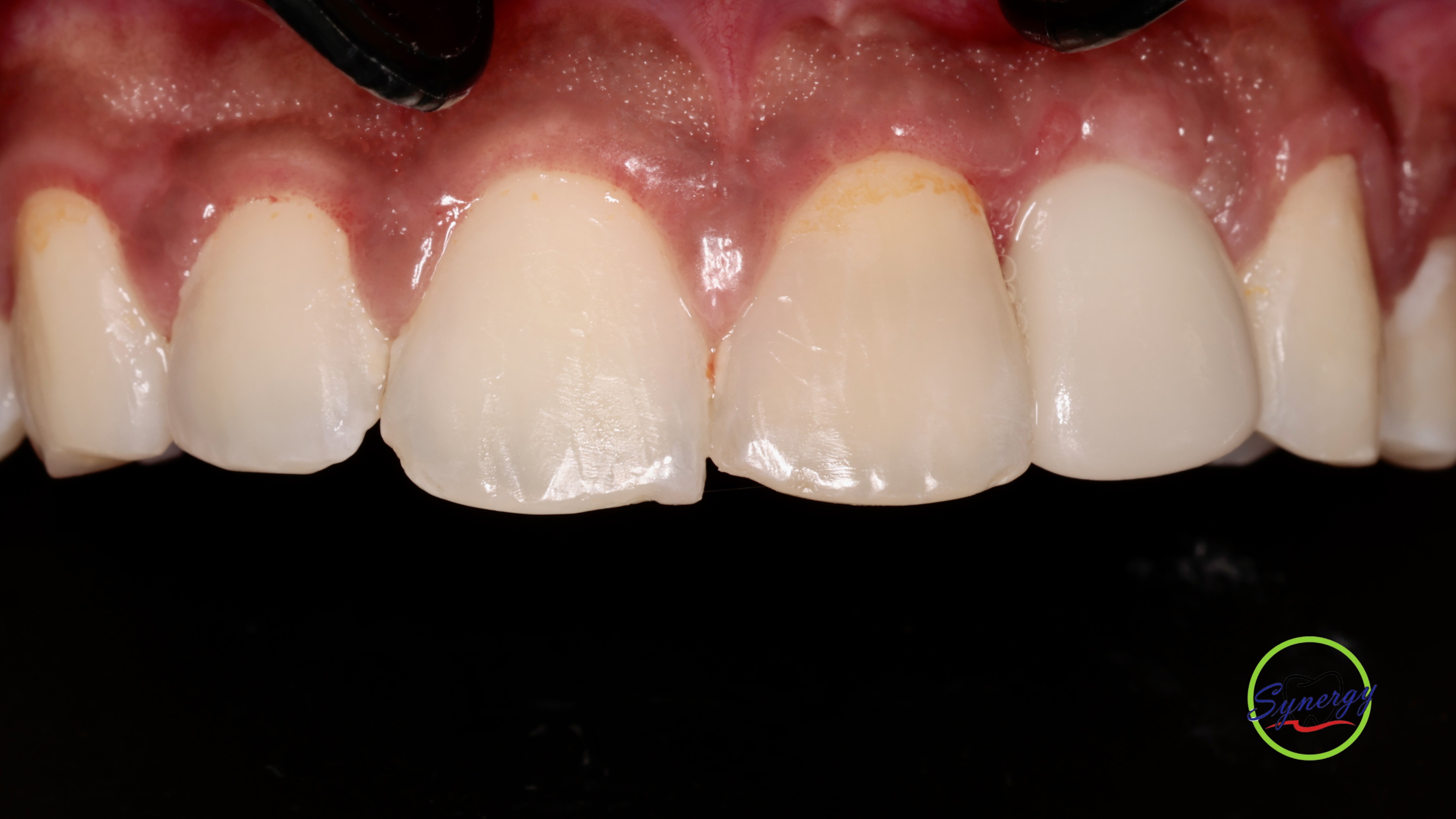 Post-operative Result