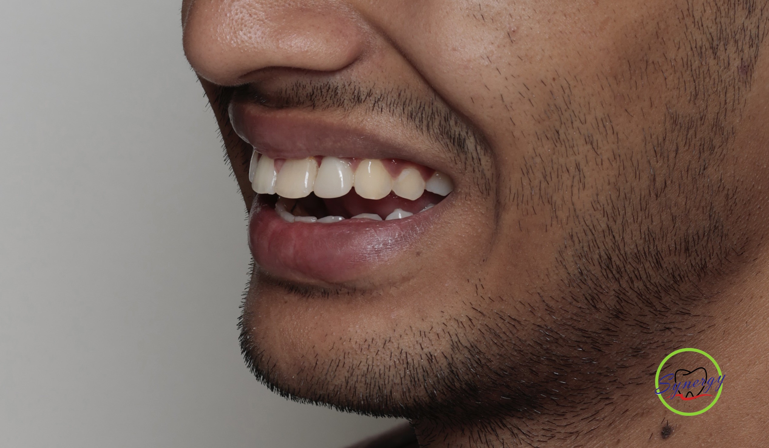 Bone Augmentation for Dental Implants