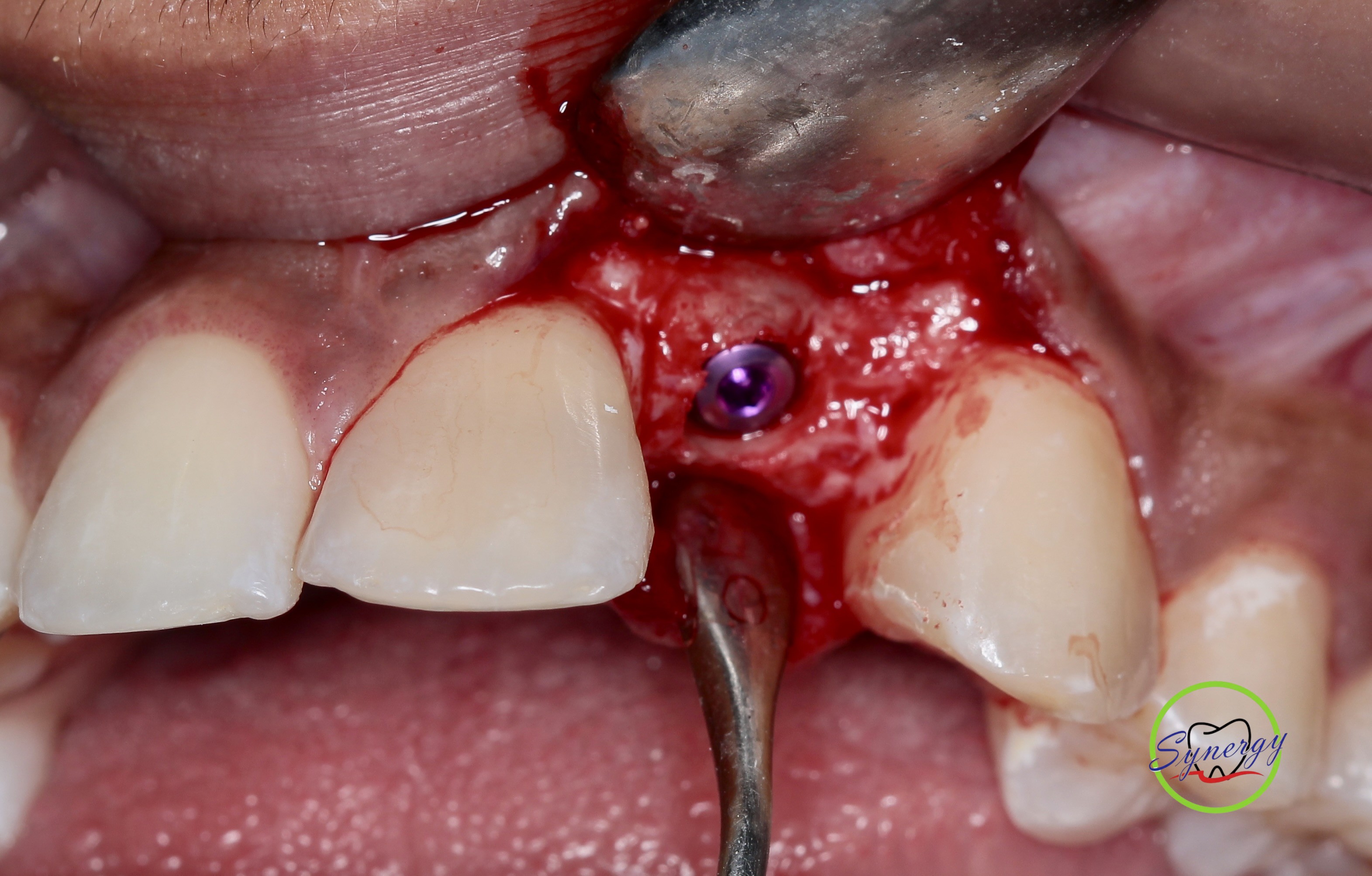 Surgical Bone Augmentation Placement
