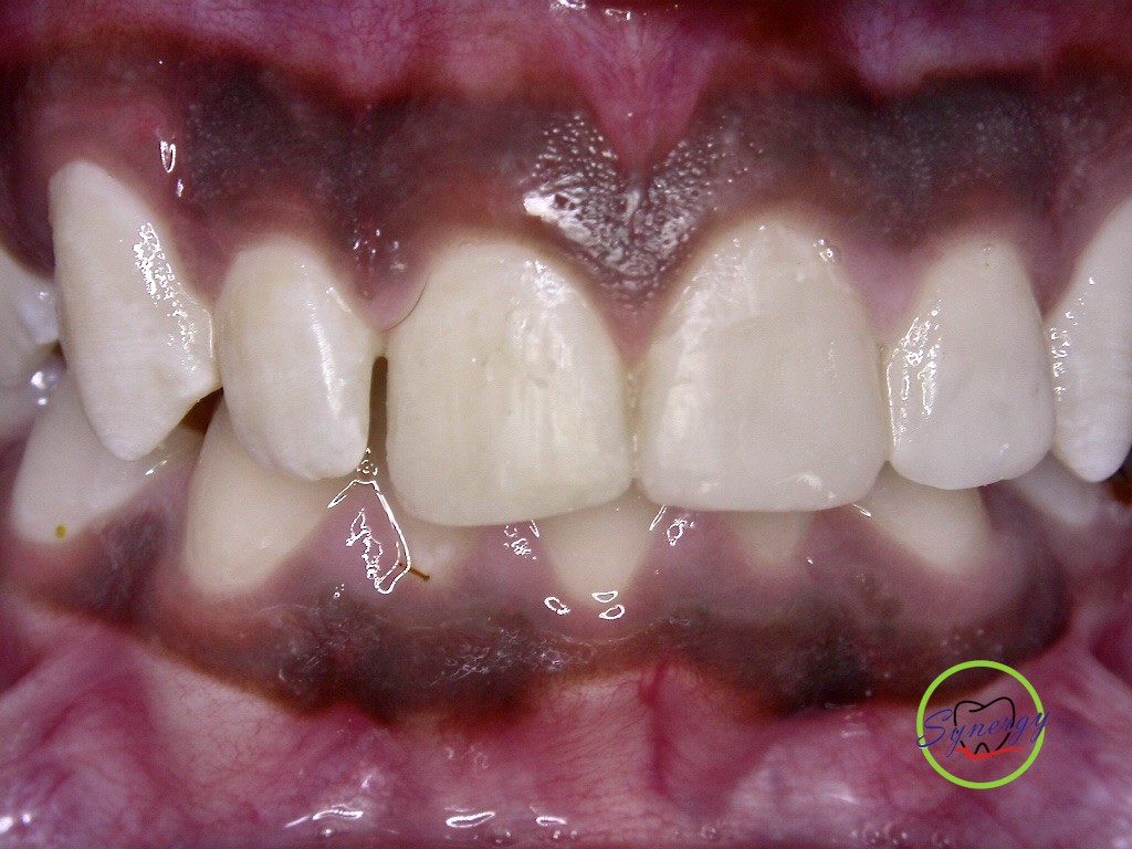 Completed restorations