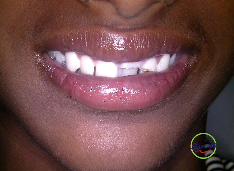 Fractured Tooth
