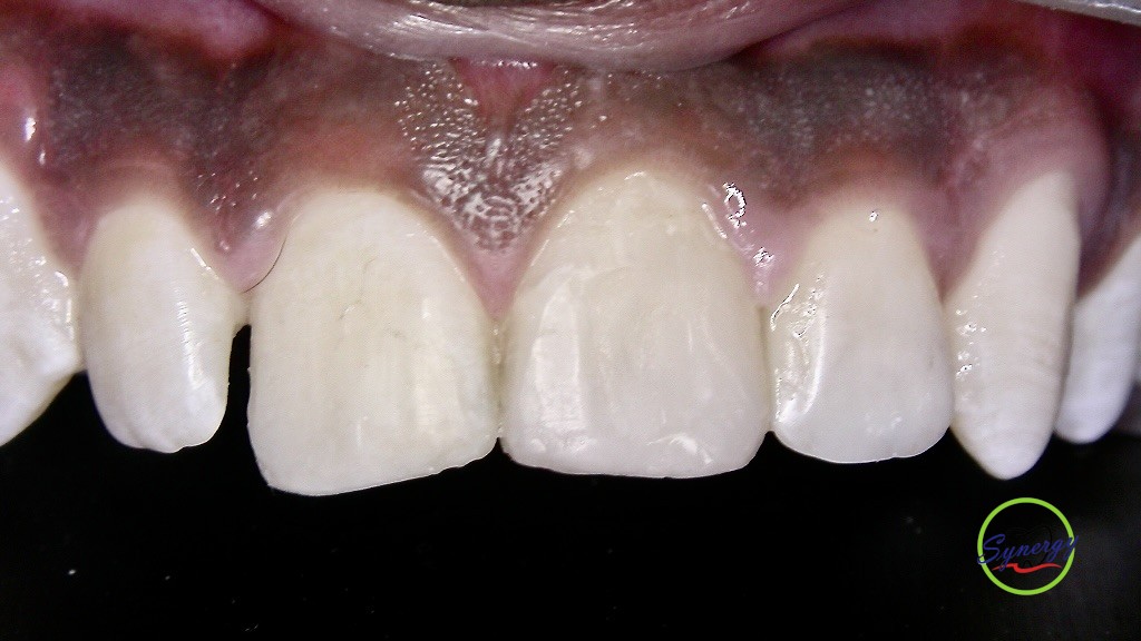 Final restorative outcome