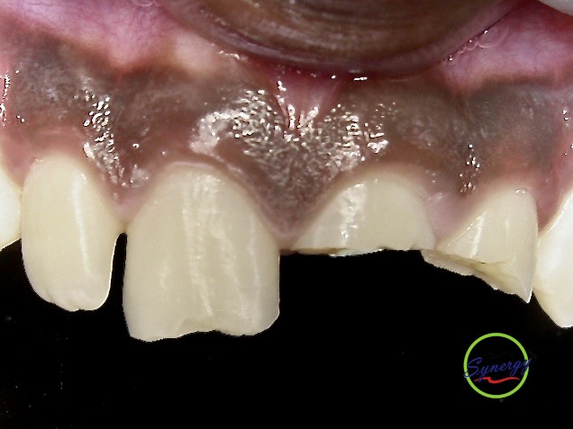 Fractured tooth case